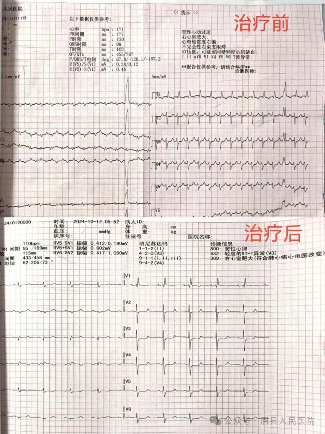 【医疗动态】射频消融术，解决患者“烦心事”